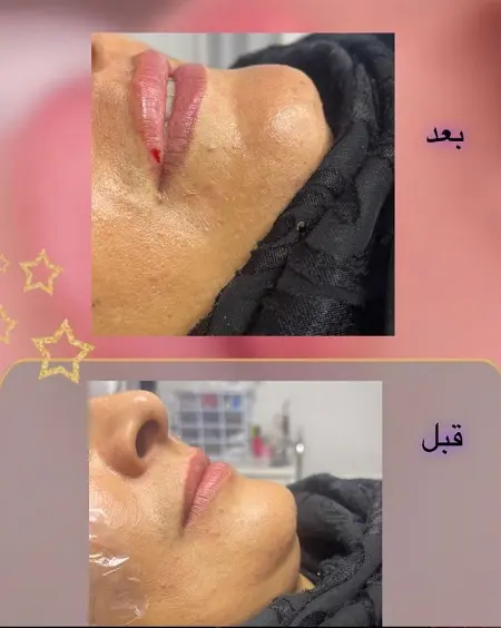 تزریق ژل در لب کلینیک زیبایی دکتر لطف آبادی در مشهد