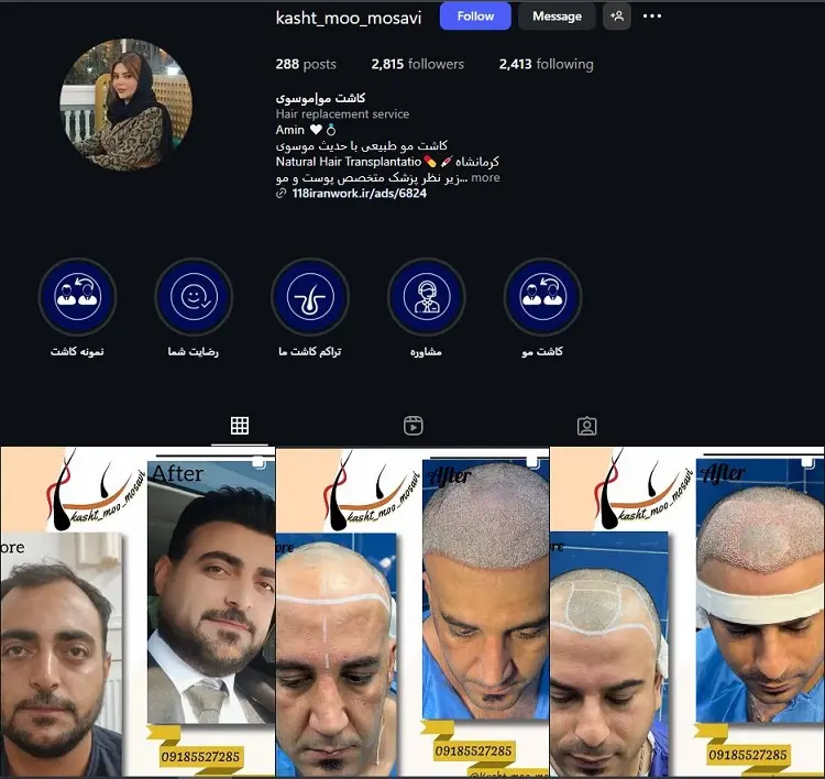دکتر کاشت مو حدیث موسوی کرمانشاه