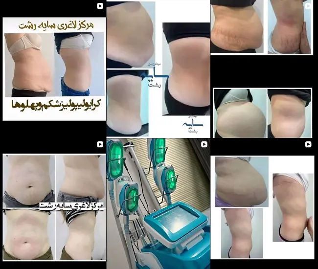 مرکز لاغری سایه در رشت