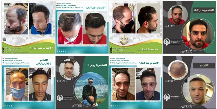 بهترین مرکز کاشت مو در مشهد، کلینیک دنیز
