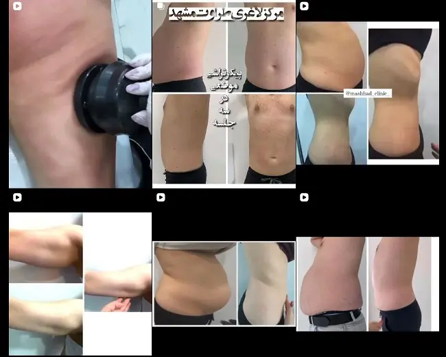 نمونه کار کلینیک لاغری طراوت مشهد