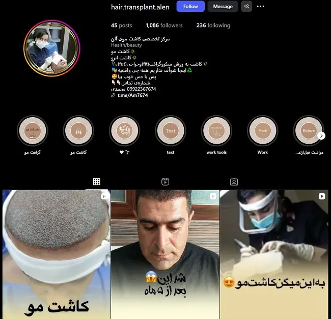 مرکز کاشت مو آلن