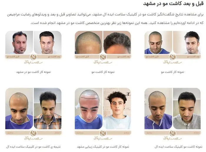 کلینیک کاشت مو ایده آل