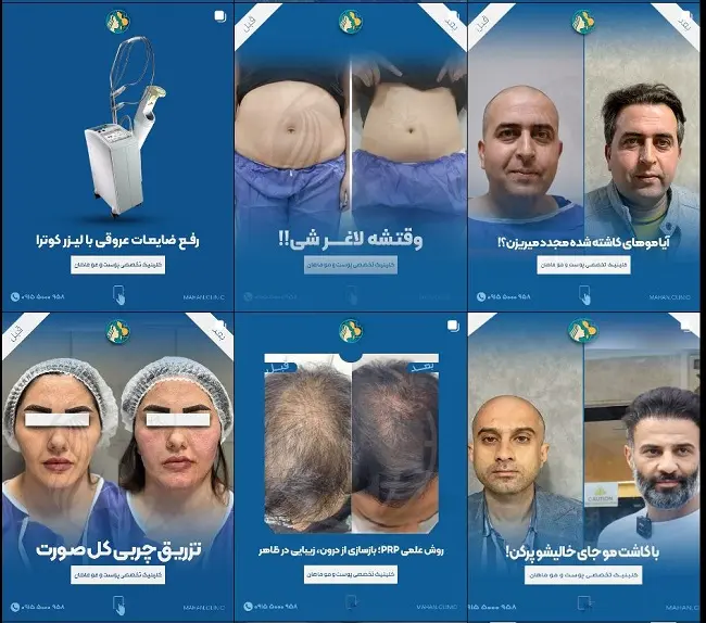 کلینیک کاشت مو ماهان