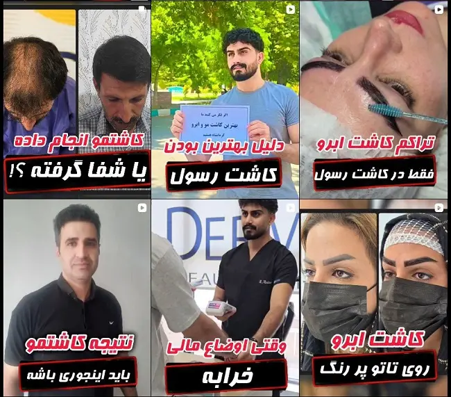 کاشت مو دکتر رسول عزیزی در کرمانشاه