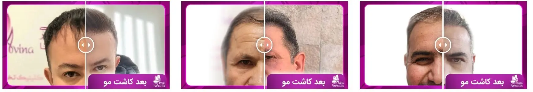 کاشت مو آوینا در تهران