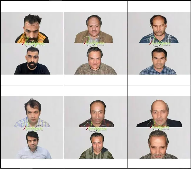 کلینیک کاشت مو روبیان در مشهد