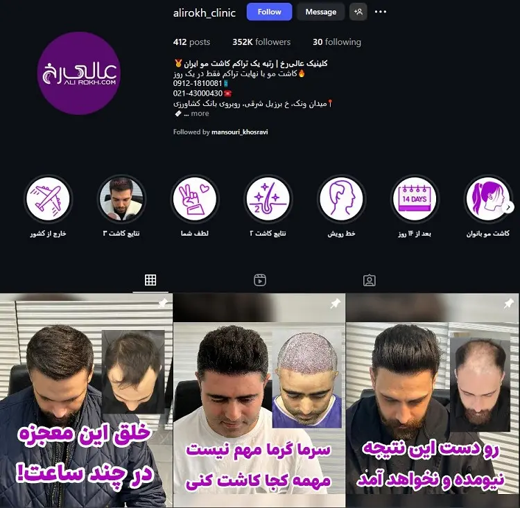 کلینیک کاشت مو عالی رخ در تهران