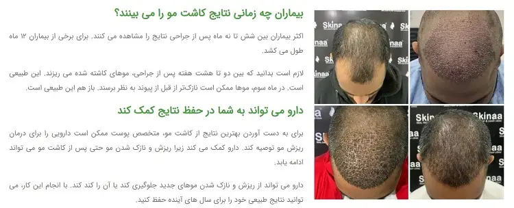 کلینیک کاشت مو پارسی در اصفهان