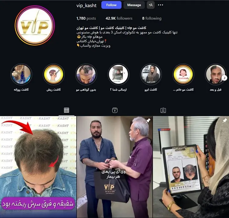 کلینیک کاشت مو vip تهران