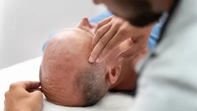 بهترین کلینیک و دکتر کاشت مو در کرمانشاه