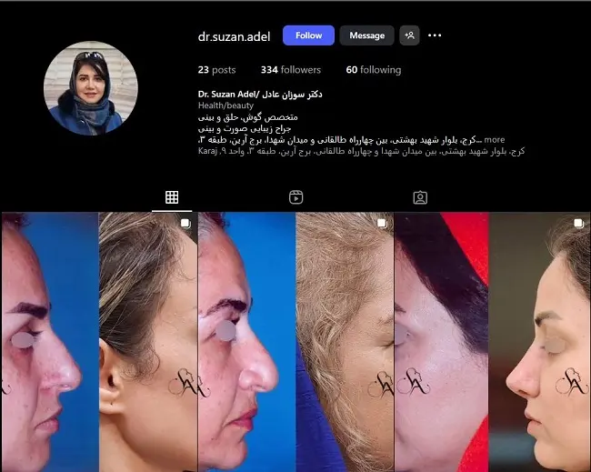 دکتر سوزان عادل شکر، جراح خانم عمل بینی در البرز