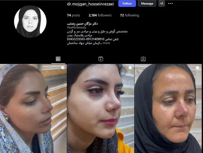 دکتر مژگان حسین رضایی، جراح خانم عمل بینی در کرمان