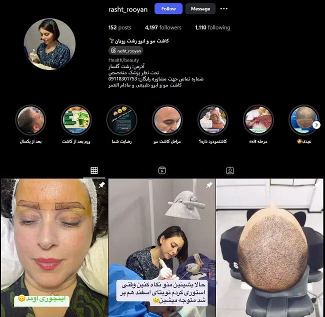 مرکز کاشت مو رشت رویان