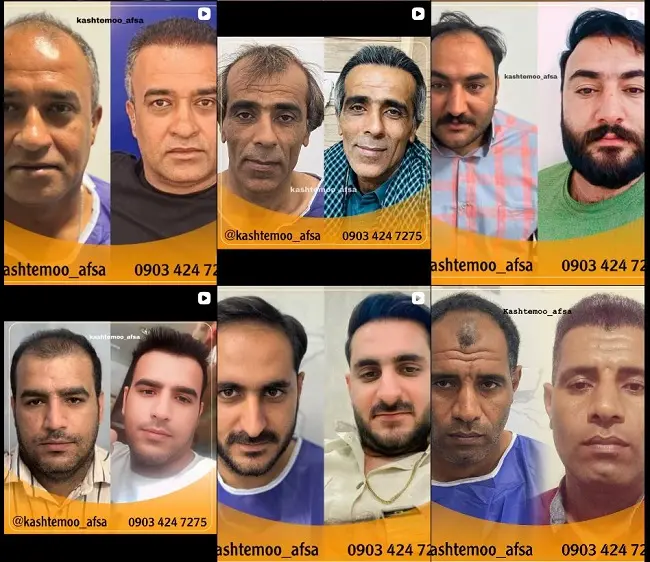 کاشت مو افسا بندرعباس