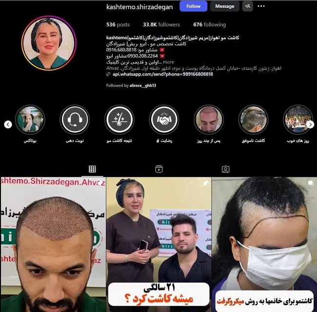 بهترین دکتر کاشت مو در اهواز، دکتر مریم شیرزادگان