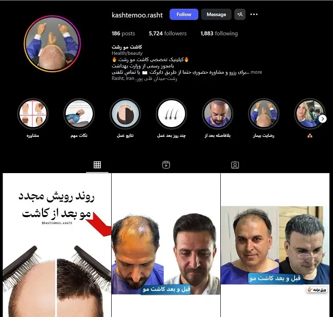 کلینیک کاشت مو رشت