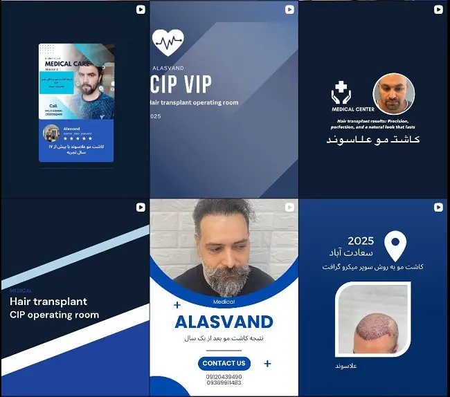 کلینیک تخصصی کاشت مو فرانک علاسوند