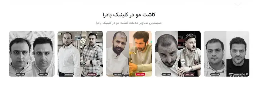 کلینیک کاشت مو پادرا بندرعباس