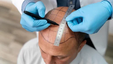بهترین کلینیک و دکتر کاشت مو در تبریز