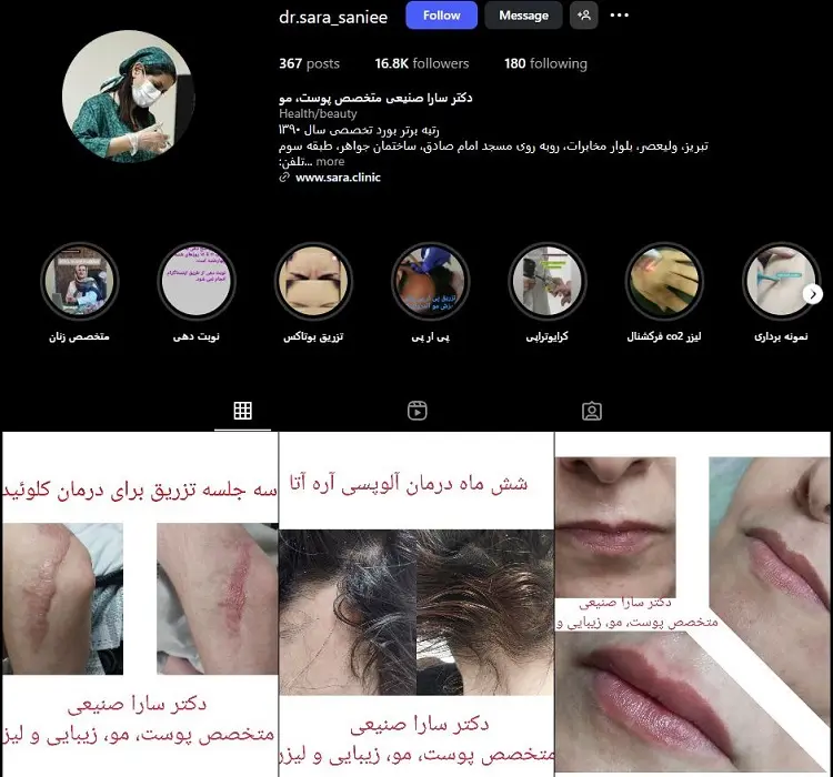 دکتر تزری ژل لب سارا صنیعی تبریز