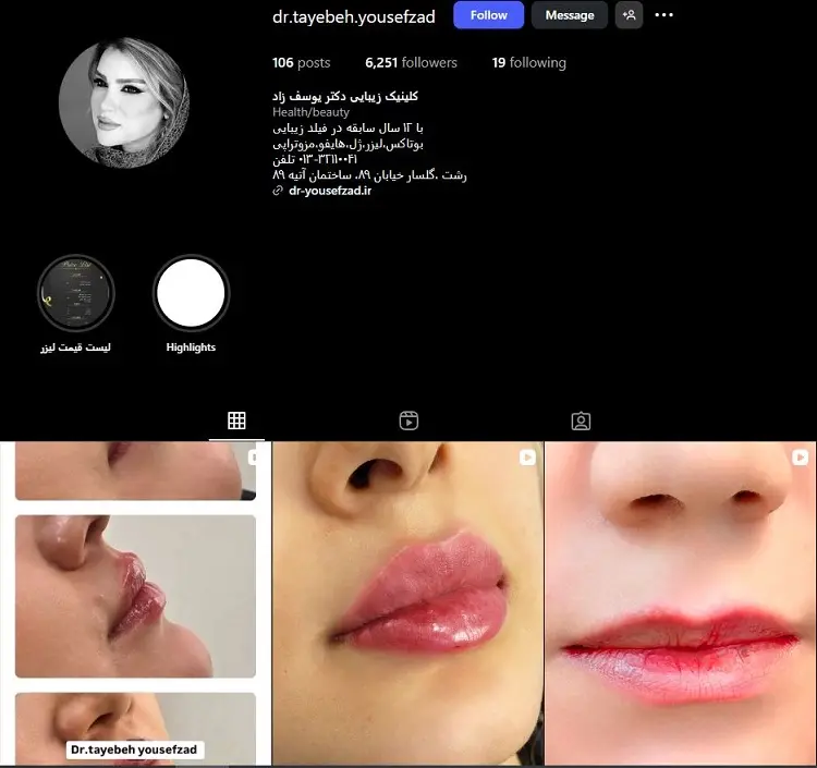 دکتر طیبه یوسف زاد، بهترین دکتر تزریق ژل لب در رشت