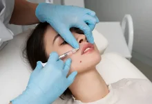بهترین دکتر تزریق ژل لب در تهران